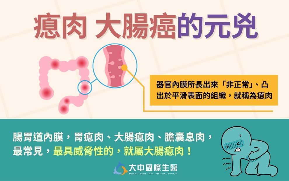 別以為只是瘜肉，它是大腸癌的元凶